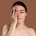 Cara Mengatasi Blind Pimple Tanpa Meninggalkan Bekas yang Efektif