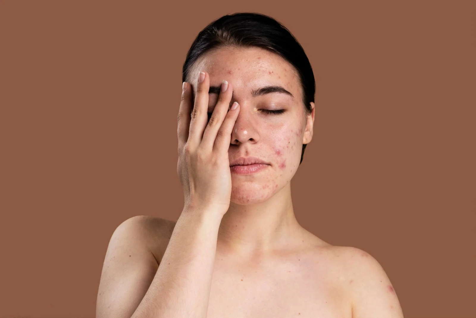 Cara Mengatasi Blind Pimple Tanpa Meninggalkan Bekas yang Efektif