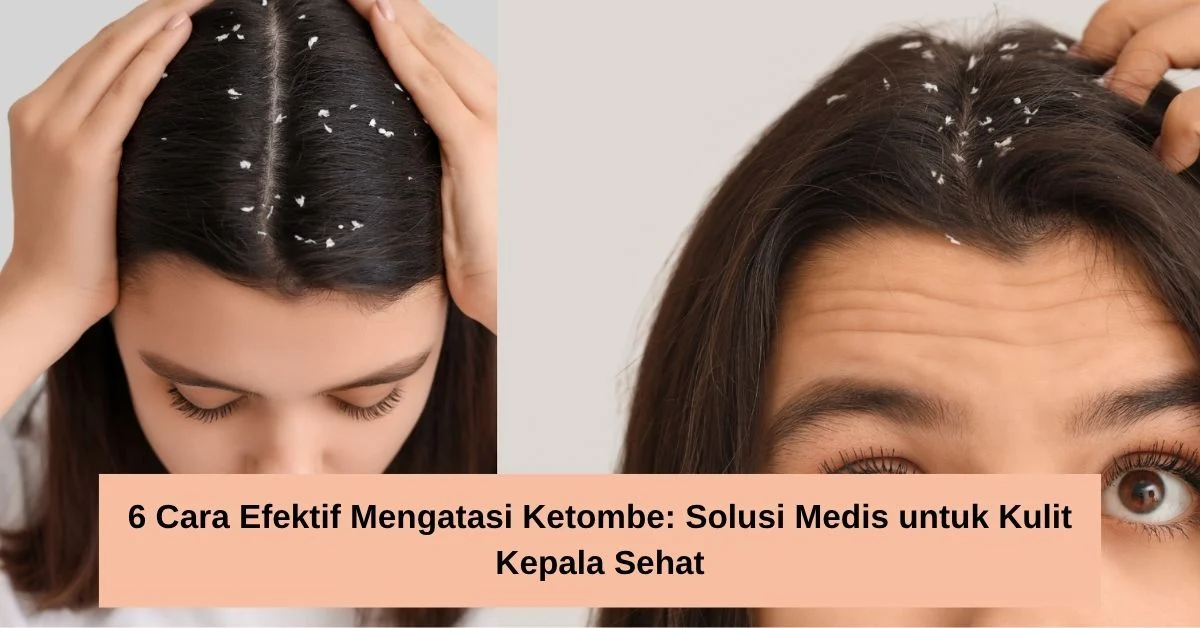 Terungkap! Cara Mengatasi Masalah Kulit Kepala Kering yang Sering Disalahartikan Sebagai Ketombe Biasa