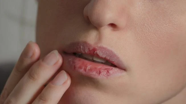 Cara Mengatasi Bibir Pecah-pecah Akibat Terlalu Sering Pakai Lipstik Liquid Matte