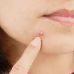 Jerawat Muncul di Kulit Kering? Ini 5 Alasan yang Perlu Kamu Ketahui